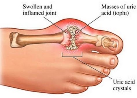 nấm lim xanh giúp hết bệnh gout