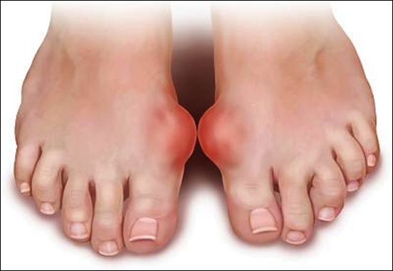 Sự thật về nấm lim xanh hỗ trợ giúp hết bệnh gout