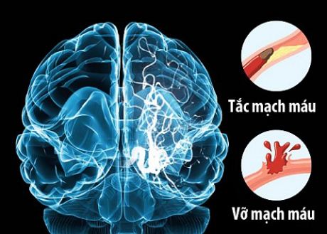 Tai biến mạch máu não rất nguy hiểm