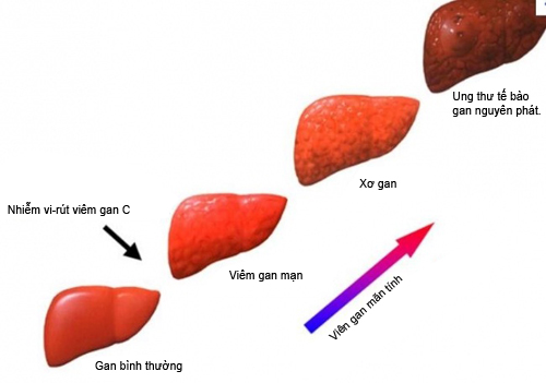 nấm lim làm lành ung thư gan